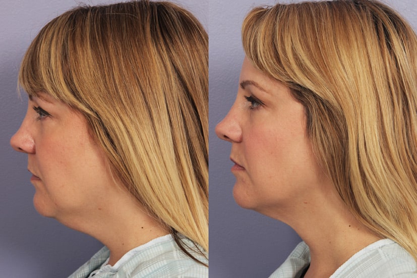 Zijaanzicht van voor en na afbeelding van een vrouw die een koele beeldhouwbehandeling in haar nek kreeg