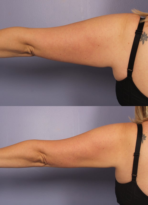 Voor en na afbeelding van de armen van een vrouw na het ontvangen van een koele beeldhouwbehandeling