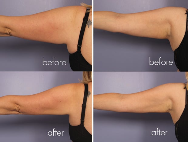 Voor en na collage van de armen van een vrouw na het ontvangen van een koele beeldhouwbehandeling